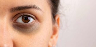 Health benefits to remove dark circles in under your eyes