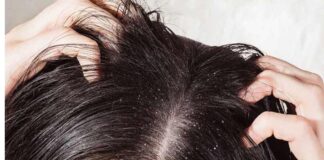 People suffering from dandruff problem should know these things