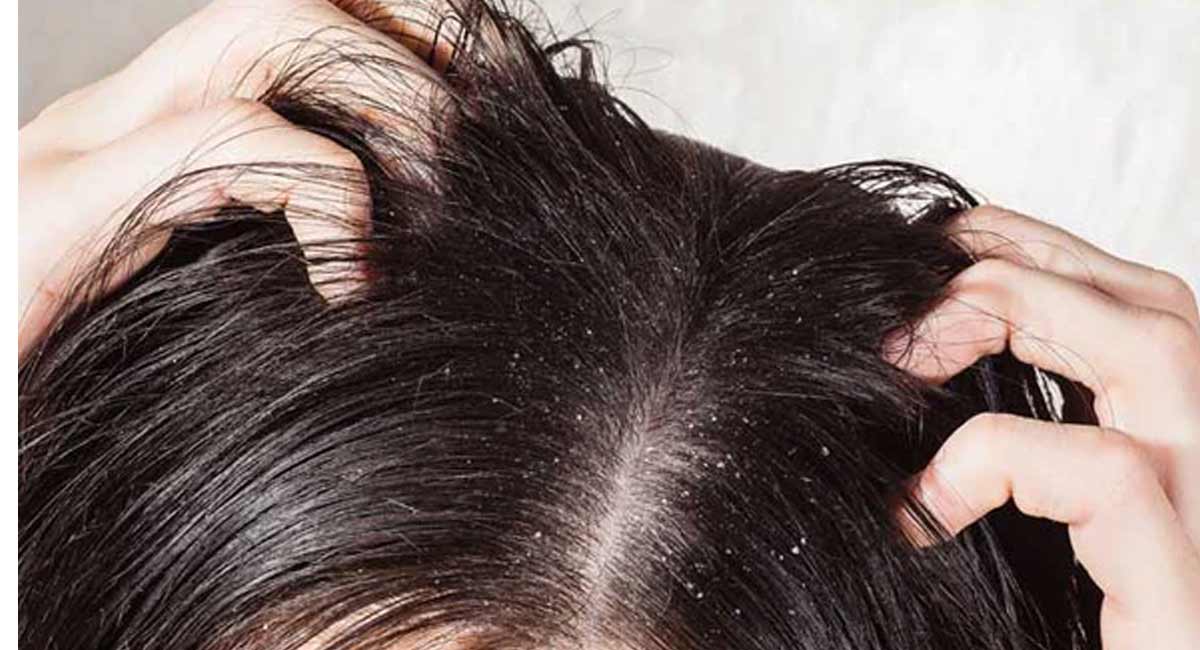 Hair Tips : చుండ్రు సమస్యతో బాధపడుతున్నారా... అయితే ఈ ఐదు విషయాల గురించి తెలుసుకోవాల్సిందే. People suffering from dandruff problem should know these things