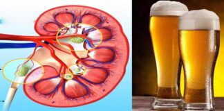 drinking beer dissolve kidney stones know the real thing