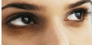 Are you suffering from dark circles under the eyes.. but these tips are for you