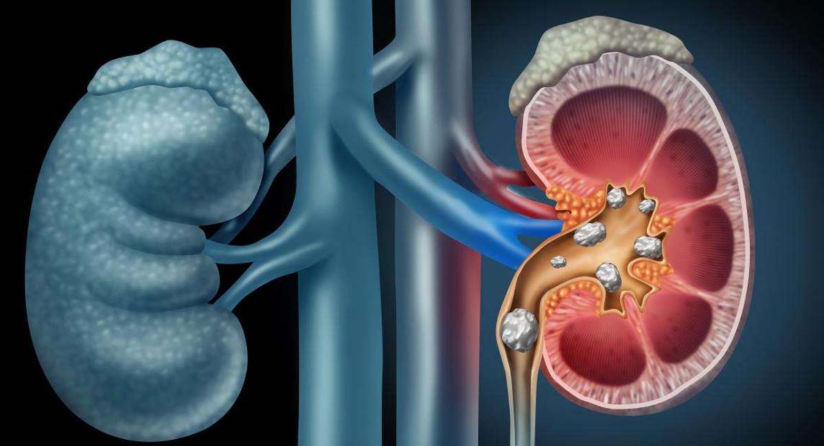 Kidney stones : మూత్రపిండాలలో స్టోన్స్ ఉన్నాయా.. మొక్కజొన్న పీస్ తో బయటికి వచ్చేస్తాయట... Do you have stones in the kidneys, they come out with corn pieces
