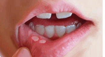 Mouth Ulcer. : నోటి పూత సమస్యలు మిమ్మల్ని వెంటాడుతున్నాయా.? అయితే ఈ టిప్స్ ఫాలో అవ్వాల్సిందే.