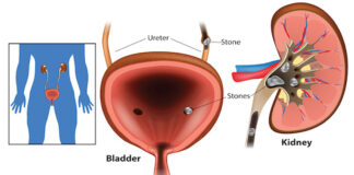 why-kidney-stones-actually-occur-how-to-control-them-naturally